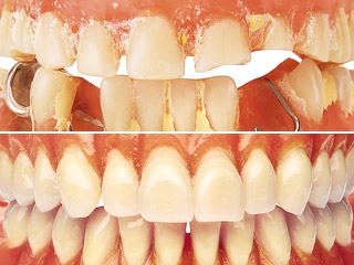 Starostlivosť o protézu Curaprox BDC - Starostlivosť o ústa a zubnú protézu je veľmi dôležitá